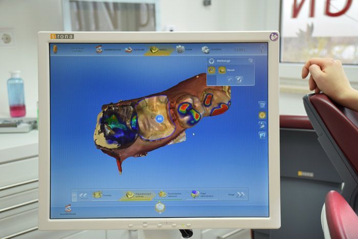 Computergestützten CEREC-Behandlung Computergestützten CEREC-Behandlung